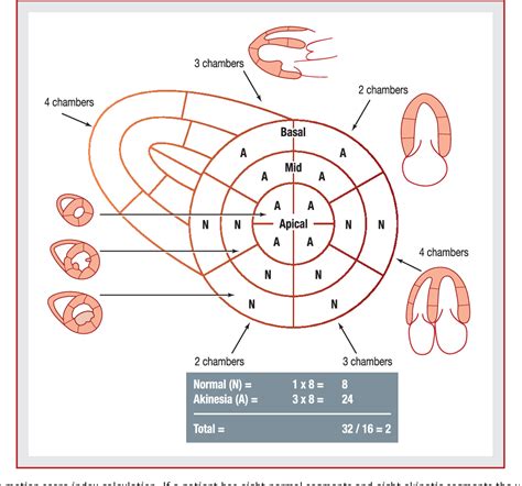 lv wall motion score index|wall motion abnormalities echocardiogram.